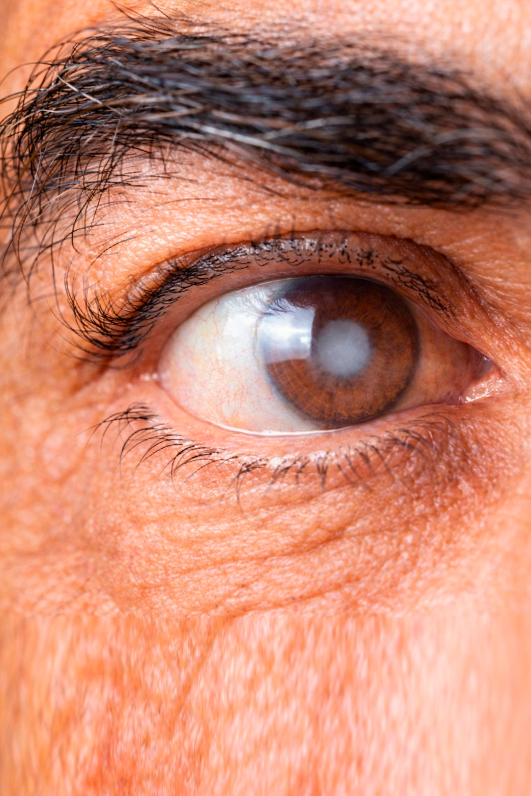 https://www.hospitaldeolhoscity.com.br/wp-content/uploads/2026/02/glaucoma-1.jpg
